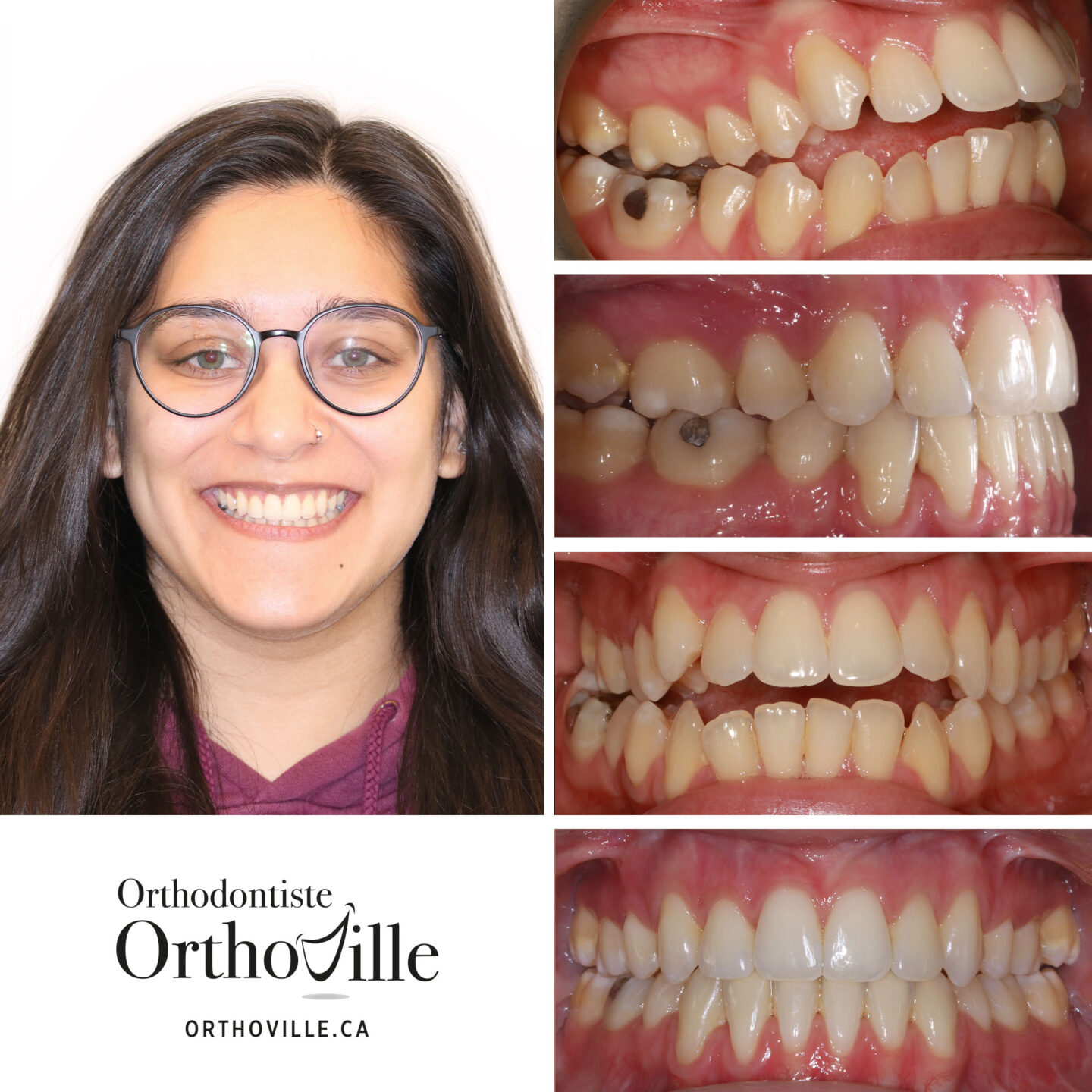 Orthodontist Blainville, Montreal and Terrebonne Orthoville Clinic