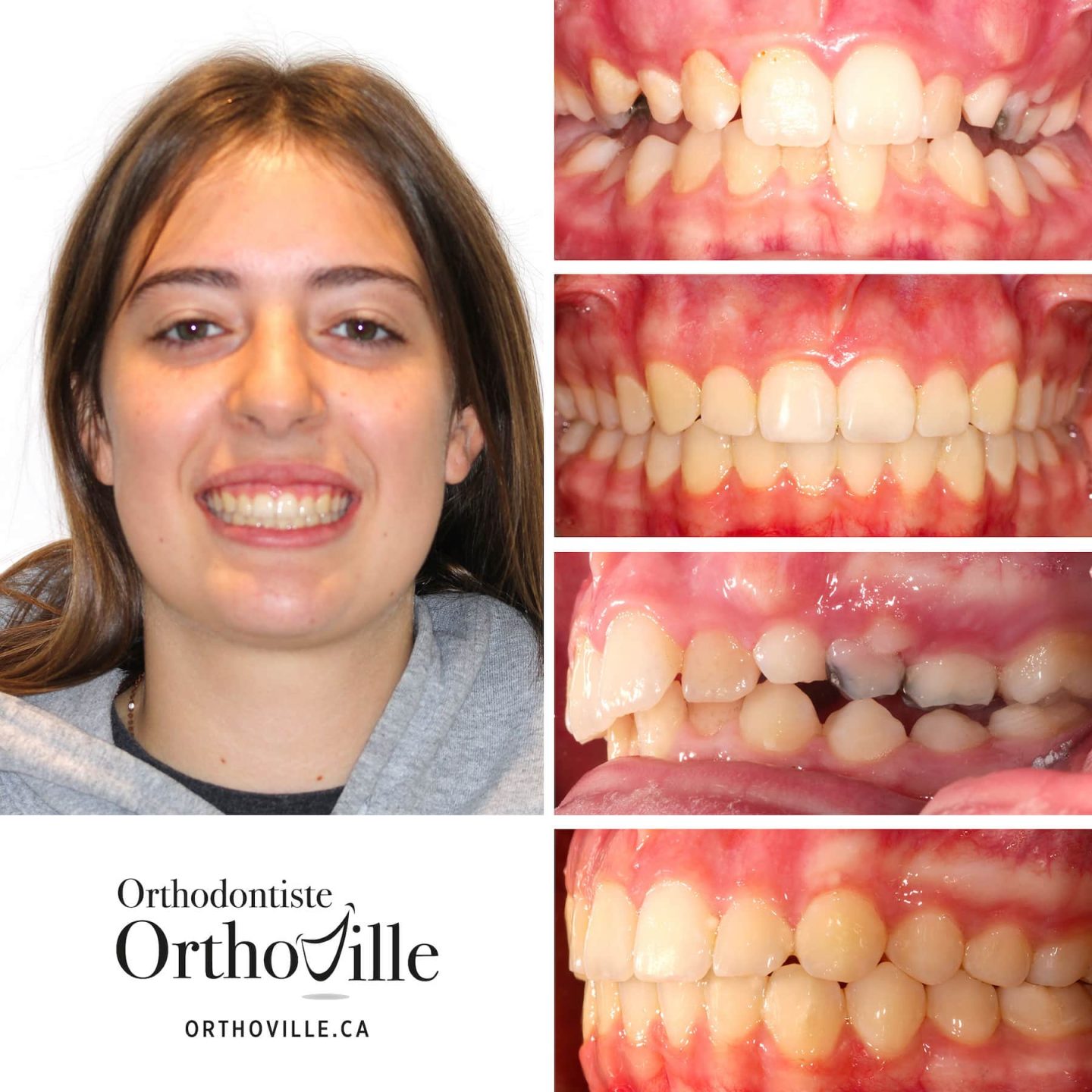 Orthodontiste à Blainville, Montréal et Terrebonne Orthoville